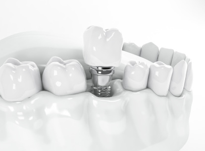 Jak wygląda wszczepienie implantu zęba